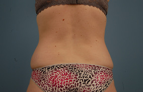 Abdominoplasty Before & After Image