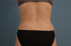 Abdominoplasty Before & After Image