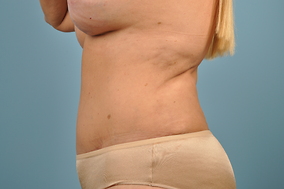 Abdominoplasty Before & After Image