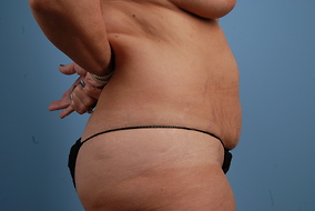 Abdominoplasty Before & After Image