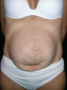 Abdominoplasty Before & After Image