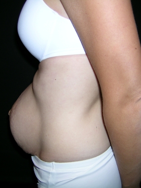 Abdominoplasty Before & After Image