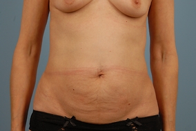 Abdominoplasty Before & After Image