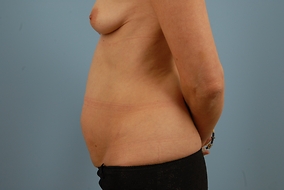 Abdominoplasty Before & After Image