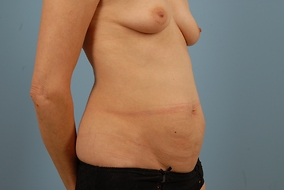 Abdominoplasty Before & After Image