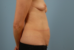 Abdominoplasty Before & After Image