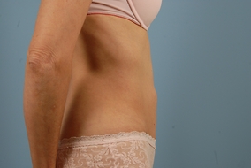 Abdominoplasty Before & After Image