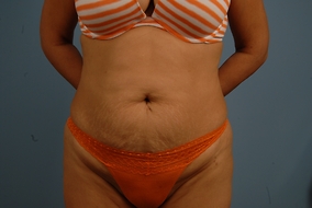 Abdominoplasty Before & After Image