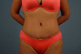 Abdominoplasty Before & After Image