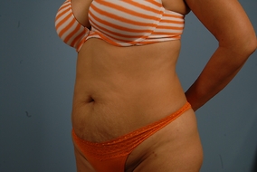 Abdominoplasty Before & After Image