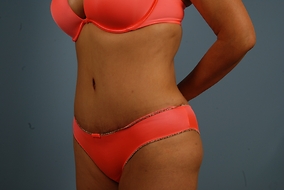 Abdominoplasty Before & After Image