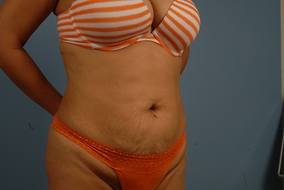 Abdominoplasty Before & After Image