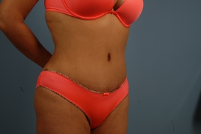 Abdominoplasty Before & After Image