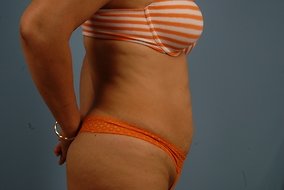 Abdominoplasty Before & After Image
