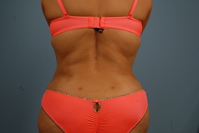 Abdominoplasty Before & After Image