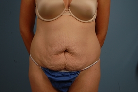 Abdominoplasty Before & After Image