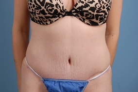 Abdominoplasty Before & After Image