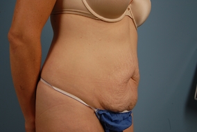 Abdominoplasty Before & After Image