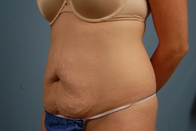 Abdominoplasty Before & After Image