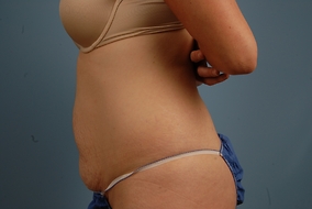 Abdominoplasty Before & After Image