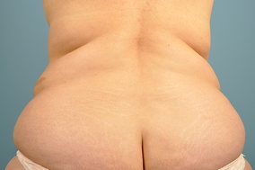 Abdominoplasty Before & After Image