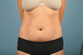 Abdominoplasty Before & After Image