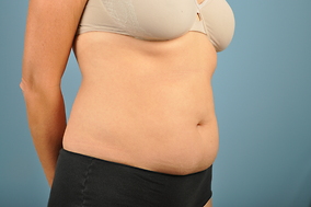 Abdominoplasty Before & After Image