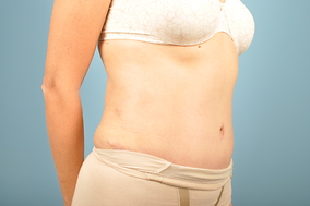 Abdominoplasty Before & After Image