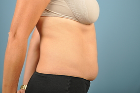 Abdominoplasty Before & After Image