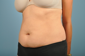 Abdominoplasty Before & After Image