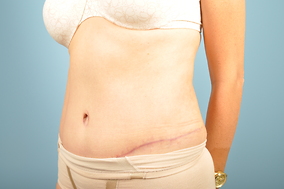 Abdominoplasty Before & After Image