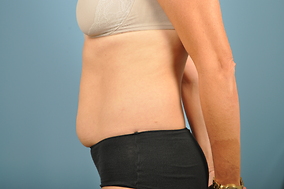 Abdominoplasty Before & After Image