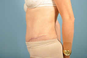 Abdominoplasty Before & After Image