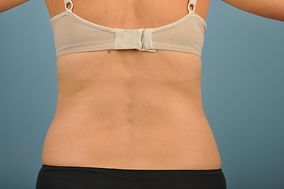 Abdominoplasty Before & After Image