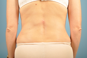 Abdominoplasty Before & After Image