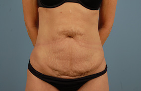 Abdominoplasty Before & After Image