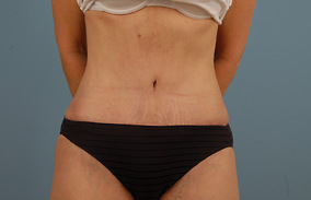 Abdominoplasty Before & After Image