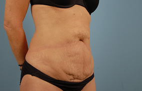 Abdominoplasty Before & After Image