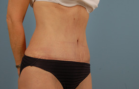 Abdominoplasty Before & After Image