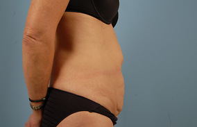 Abdominoplasty Before & After Image