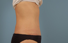 Abdominoplasty Before & After Image