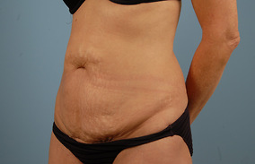 Abdominoplasty Before & After Image