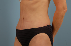 Abdominoplasty Before & After Image