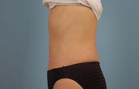 Abdominoplasty Before & After Image