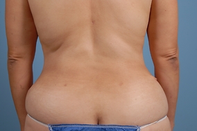 Abdominoplasty Before & After Image