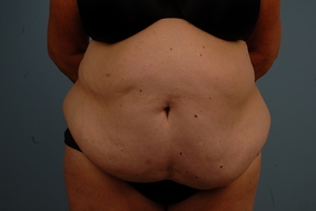 Abdominoplasty Before & After Image