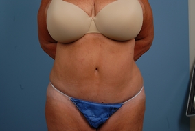 Abdominoplasty Before & After Image