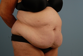 Abdominoplasty Before & After Image