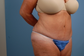 Abdominoplasty Before & After Image