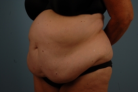 Abdominoplasty Before & After Image